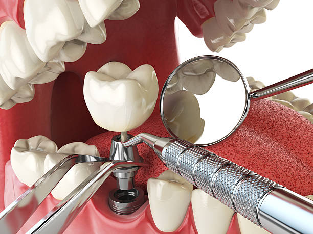 Best Emergency Tooth Extraction in Seaside, CA
